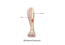 Shinbone Fractures